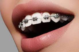 Cost of Braces in South Africa 2023